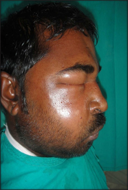 Photograph showing patient with buccal space abscess, c | Open-i