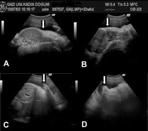 High Abdomen Thorax Ratio A Pulmonary Hypoplasia And Open I