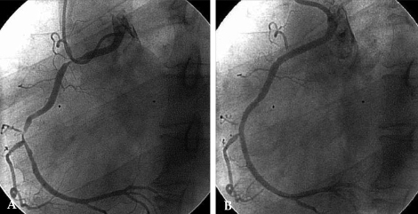 (A) Pre-intervention Image: Right Coronary Angiogram Sh | Open-i