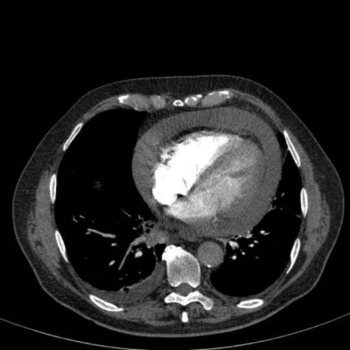 CTPA scan image through lower chest showing bilateral p | Open-i