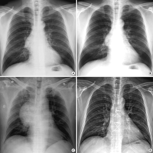 Serial radiographic changes of the superior vena cava ( | Open-i