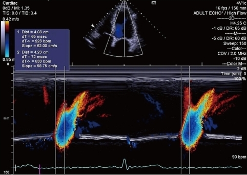 Intraventricular Early Diastolic Filling During Acute Myocardial