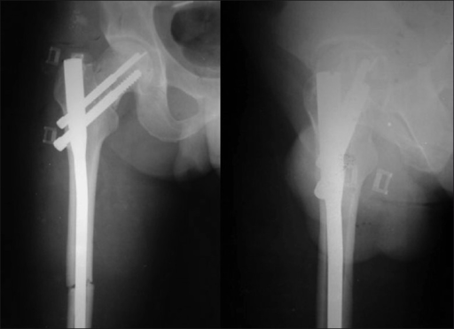 Figure 2 from Radiographic Outcomes of Osteosynthesis Using Proximal  Femoral Nail Antirotation (PFNA) System in Intertrochanteric Femoral  Fracture: Has PFNA II Solved All the Problems? | Semantic Scholar