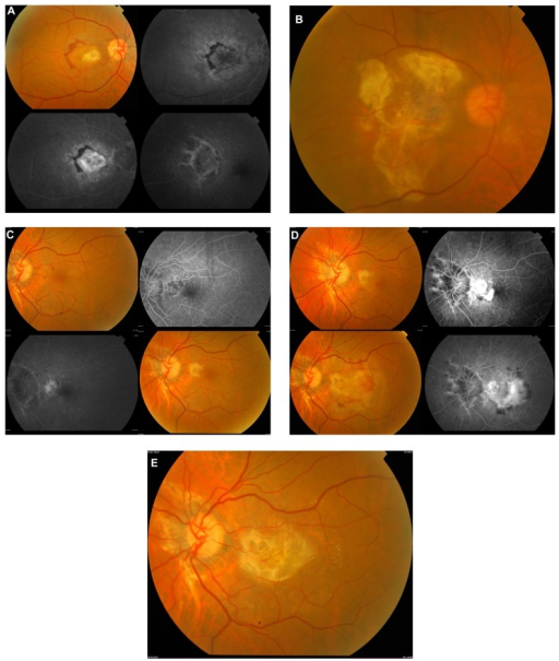 Case 1 A Active Subfoveal CNV Membrane OS With Subretinal Hemorrhage Connected To Case 1 A Active Subfoveal CNV Membrane OS With Subretinal Hemorrhage Connected To