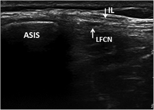 Transverse ultrasound image shows the nerve passing thr | Open-i