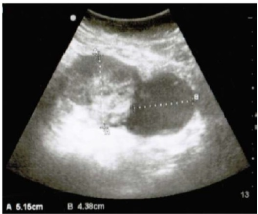 Ultrasonography at 30 weeks showing a complex adnexal m | Open-i