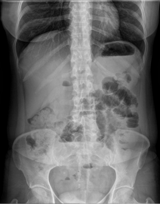 Abdominal x-ray revealed dilated small bowel segments w | Open-i