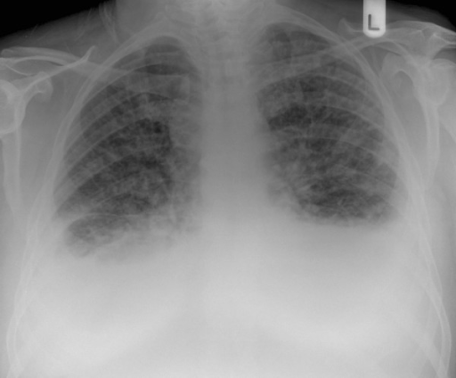 Chest X-ray: bilateral pleural effusions and extensive | Open-i