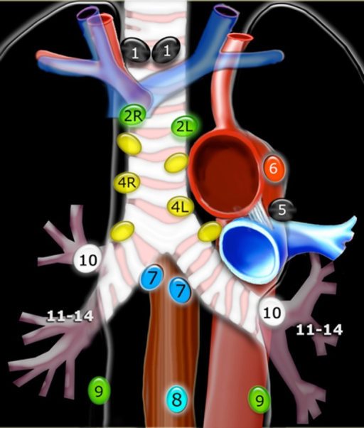 Lymph node stations in the mediastinum. Lymph node stat | Open-i