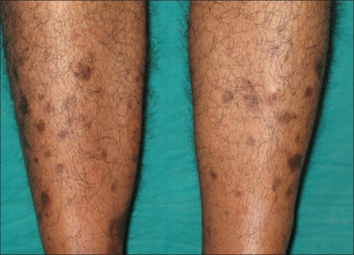 Multiple Well Defined Hyperpigmented Atrophic Macules O Open I