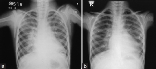 Chest X-Ray (a) Pre-operative showing cardiomegaly and | Open-i