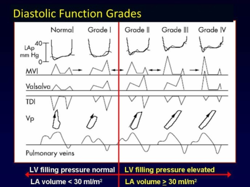 Diastolic function grades: Left ventricular (LV) diasto | Open-i