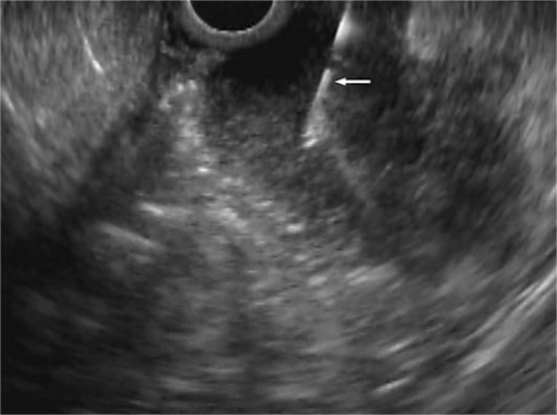 Endoscopic ultrasound image of a hypoechoic mass in the | Open-i