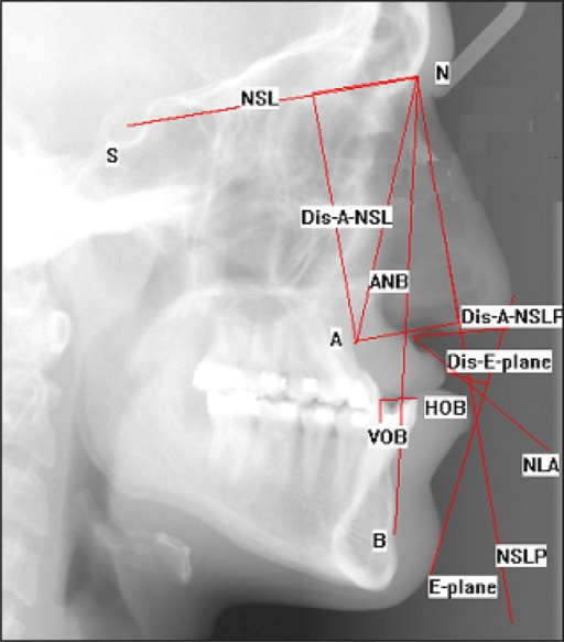 Measured Angles And Distances On Lateral Cephalometric. | Open-i