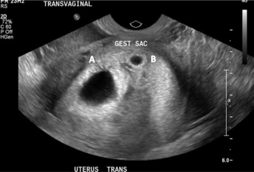 Transvaginal ultrasound of uterus showing 2 asymmetrica ...