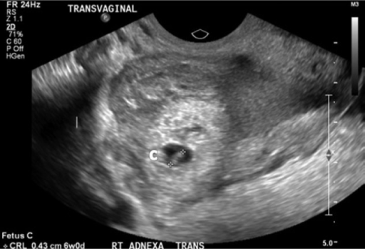 Trans L Ultrasound Of Right Adnexa Showing The Right Tubal Ectopic Pregnancy Fetus C With Trans L Ultrasound Of Right Adnexa Showing The Right Tubal Ectopic Pregnancy Fetus C With