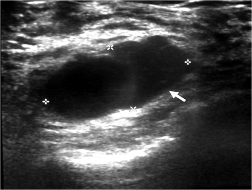 ultrasound-examination-of-the-right-breast-showing-a-we-open-i