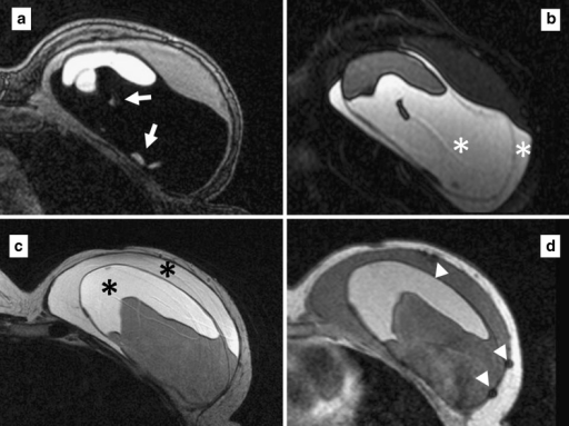 asian kitt mri of breast implant