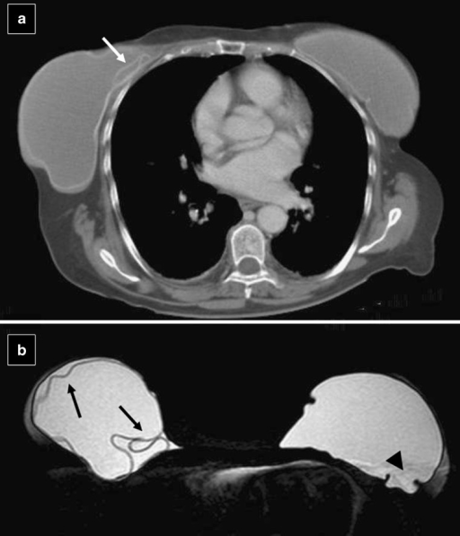 Unilateral implant rupture. (a) Axial CT scan shows sma | Open-i