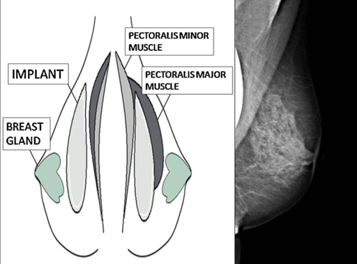 Localisation Of Breast Implants. (Left) Submammary Implant Located In ...