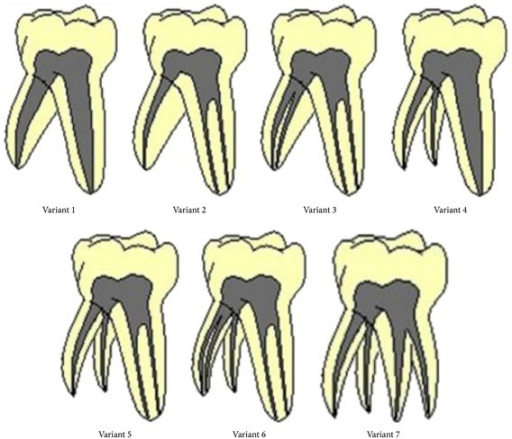 categorization of the seven variants in primary mandibu open i primary mandibular first molar