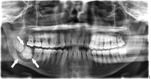 Ortho-pantomo-graphic x-ray view showing calcified mass | Open-i