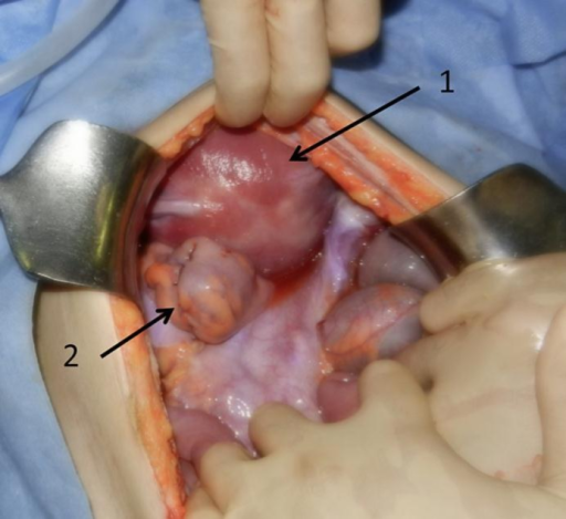 Intraoperative Findings Of Case 2 The Pregnant Uterus Open I