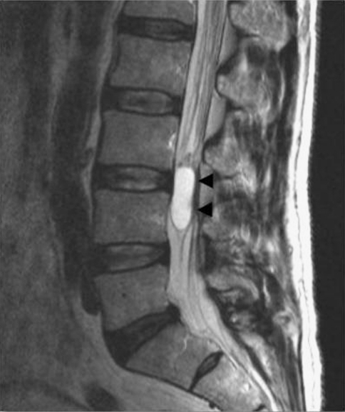 Preoperative sagittal T2-weighted MRI scan of the lumba | Open-i