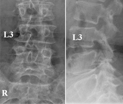 Plain radiographs showing sacralization of the fifth lu | Open-i