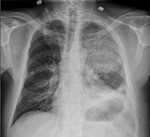 A chest radiograph shows elevation of the left hemidiap | Open-i