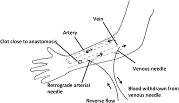 Schematic illustration of needle placement when clot bu | Open-i