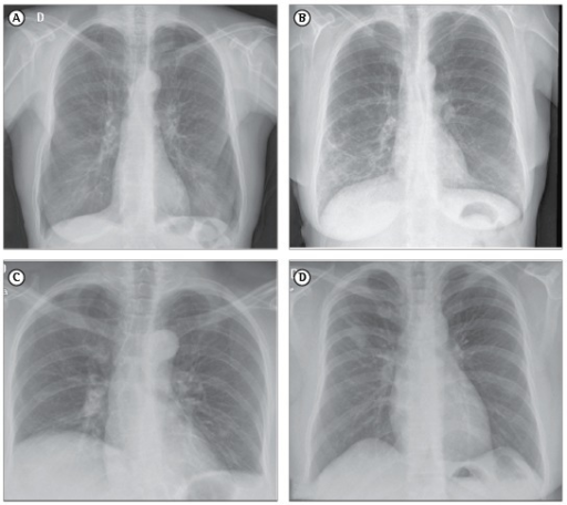 Chest X-ray patterns: (A) hyperinflation; (B) interstit | Open-i