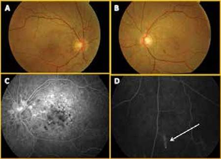 Case 2 Fundus Photography Of 47 Year Old Female Patient Revealed A Case 2 Fundus Photography Of 47 Year Old Female Patient Revealed A