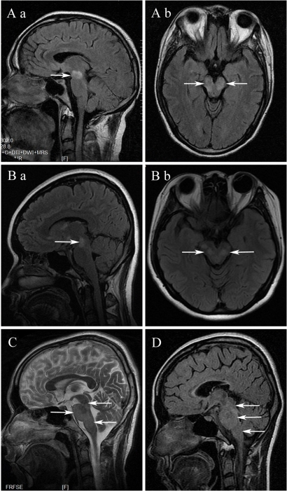 Brain stem lesions (arrows) on MRI of acute disseminate | Open-i