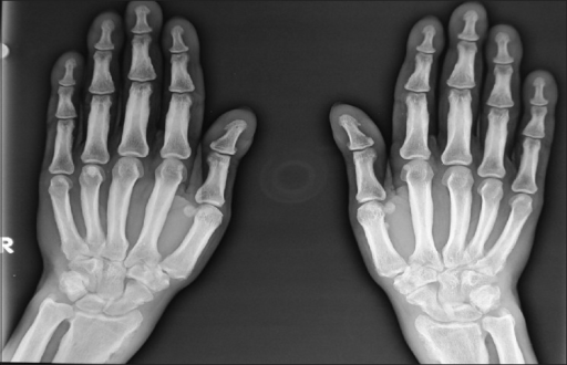 Radiograph of both hands AP view shows shaggy periostea | Open-i