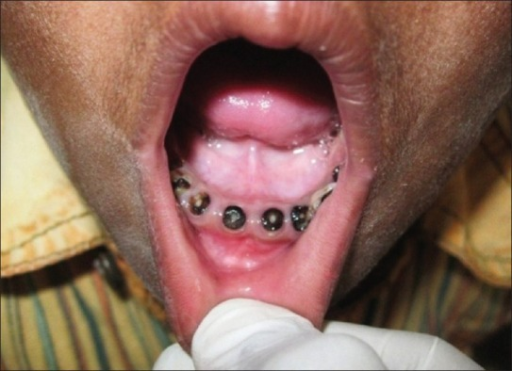 rampant dental caries involving the deciduous teeth open i rampant caries