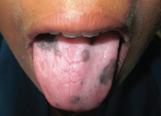 hyperpigmentation-seen-on-the-dorsal-surface-of-the-ton-open-i