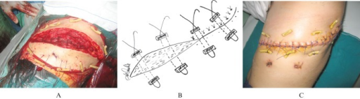 Retention sutures 2024