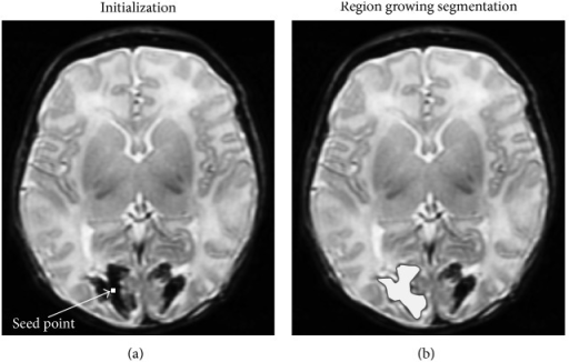 An Example Of Region Growing Segmentation Of A Brain Le Open I