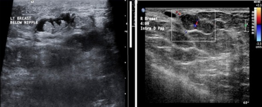multiplex intraductalis papillomatosis