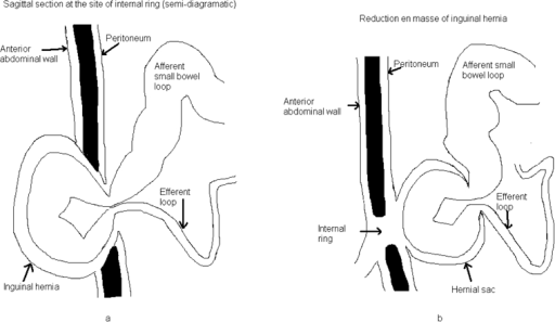 A Diagram Of Inguinal Hernia At The Site Of Inguinal Open I