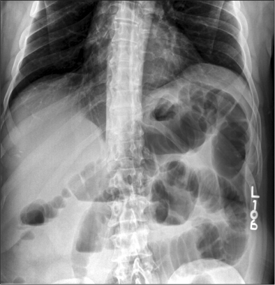 Simple Abdominal X-ray Presents Multiple Dilated Small 