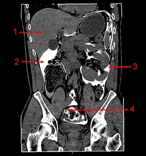 Ct Abdomen Coronal With Rectal Contrast1 Liver 2 Open I