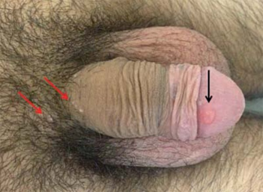 Molluscum Contagiosum On The Penis 29