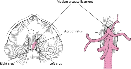 The Fibrosis Of The Ligament Of The Median Arcuate Prod Open I