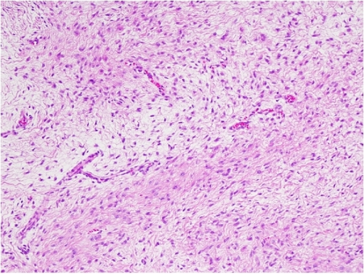 Low-grade fibromyxoid sarcoma with alternating fibrous | Open-i