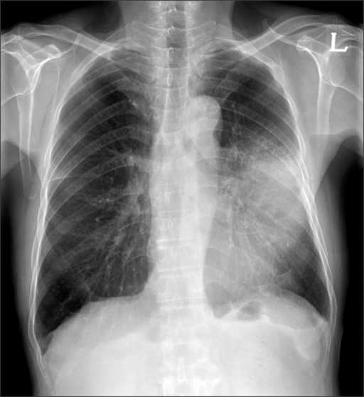 Chest x ray showed the ill defined patchy mass opacity open i