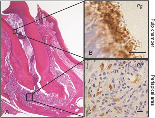 Dental Pg infection induces periapical granuloma.Severe | Open-i