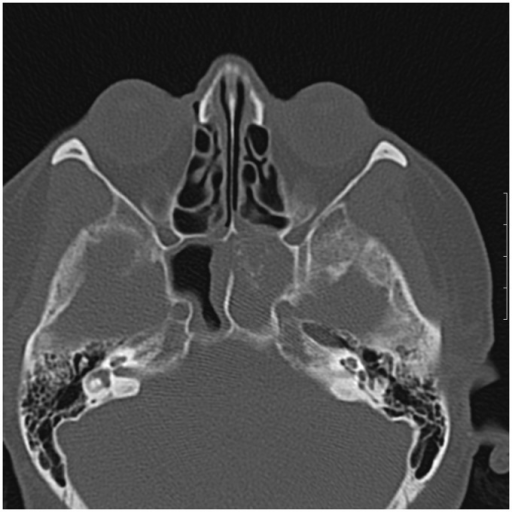 Axial unenhanced CT scan showing opacification of the l | Open-i