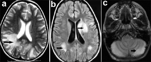 MRI of brain in CIDD. (a) T2-W axial image of ADEM pati | Open-i